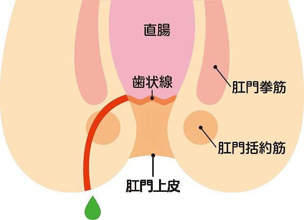 痔ろう(あな痔)