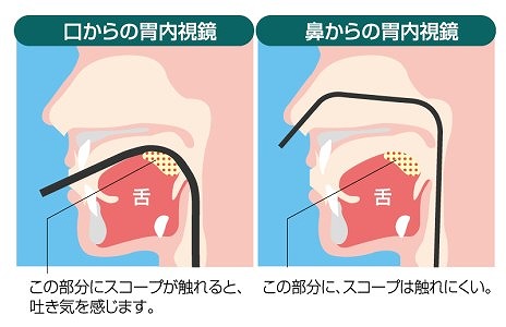 鼻からの経鼻検査と、口からの経口検査からお選びいただけます