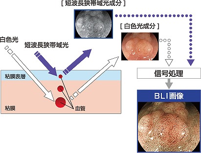 BLI（Blue Light Imaging）